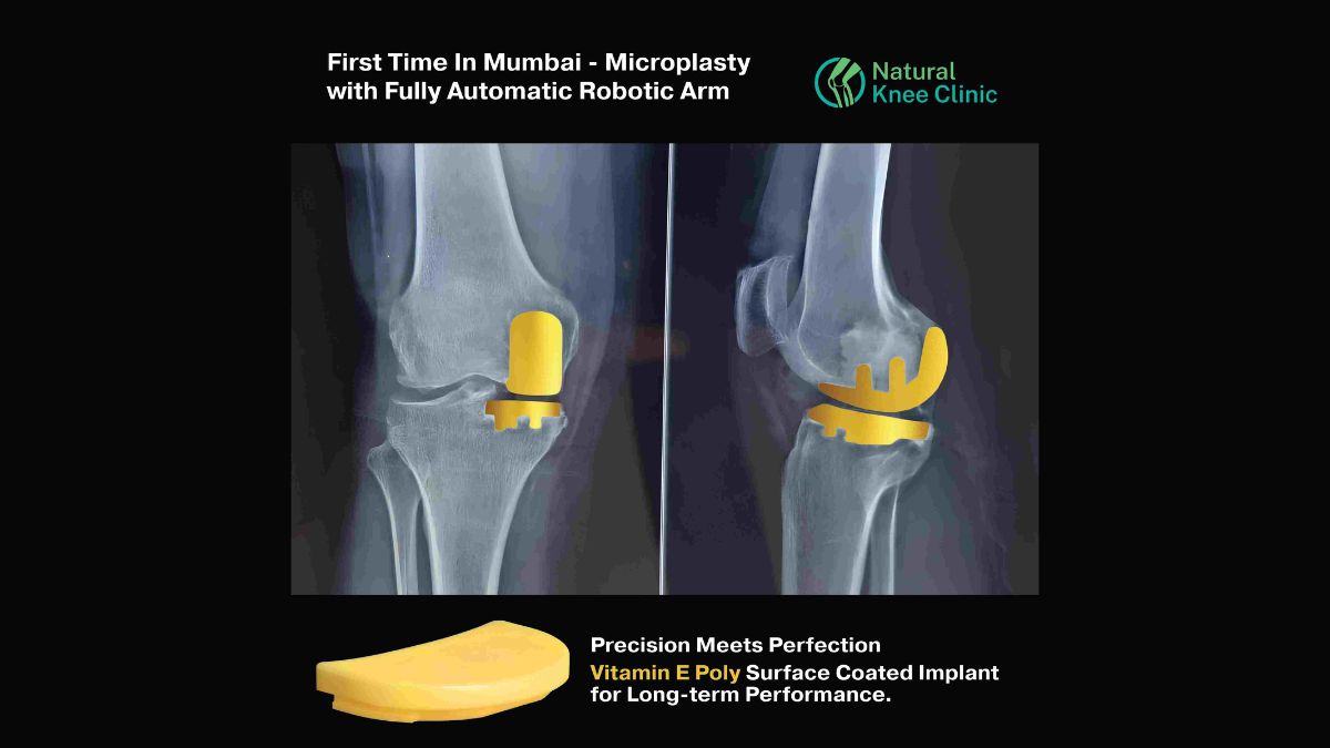 Medical Breakthrough: Preserve Your Natural Knee with Absolute Precision Robotic Microplasty Surgical Technique